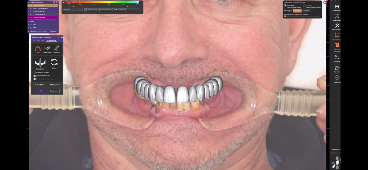 Виртуальное планирование улыбки.