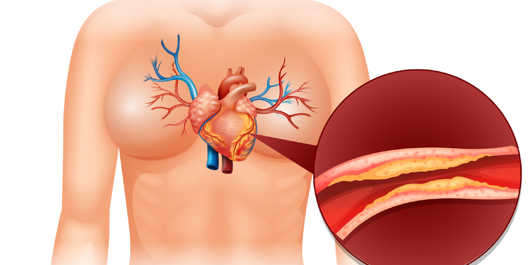 Холестерин: хороший, плохой, злой :)