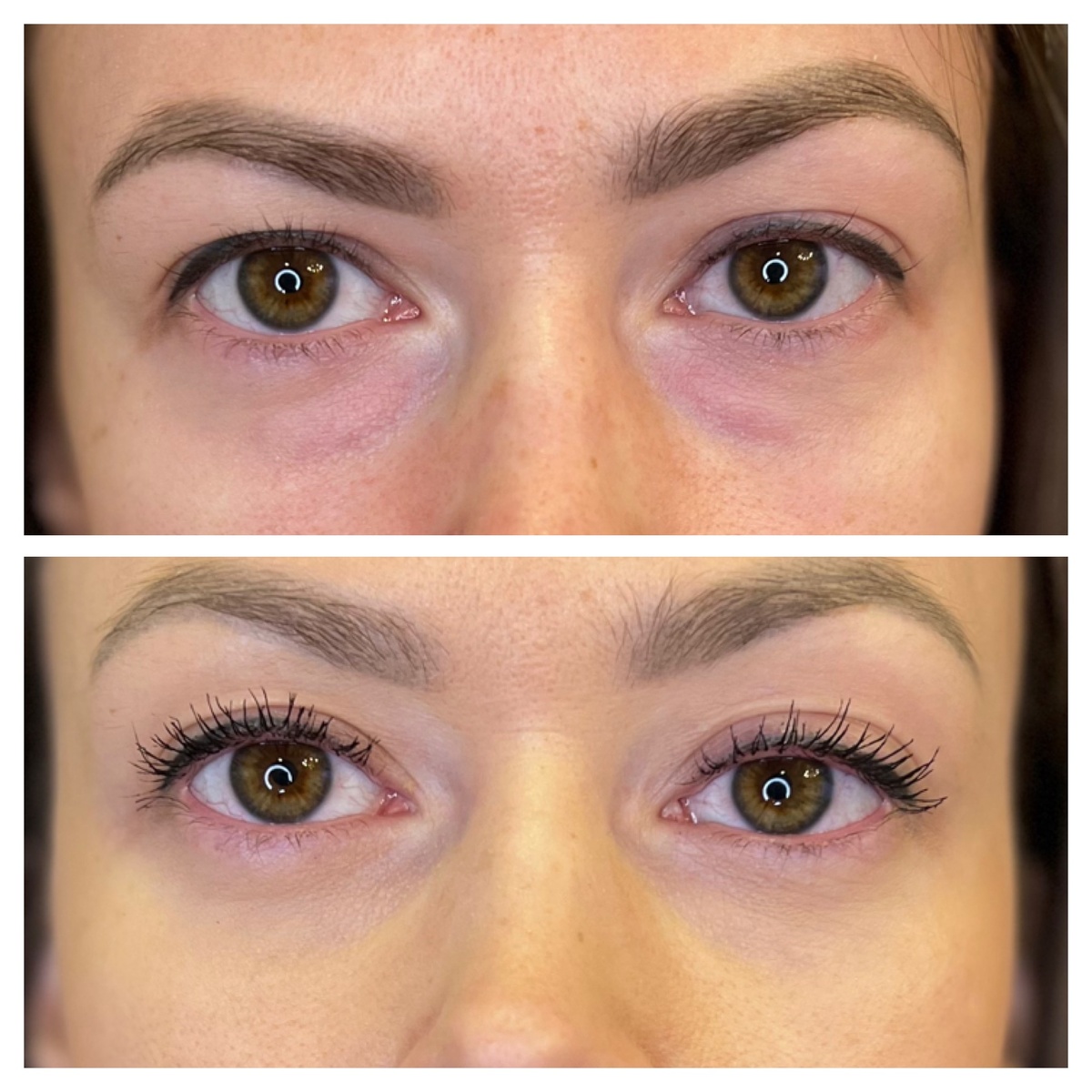 Блефаропластика фото: работа пластического хирурга Гузаль Исамутдиновой