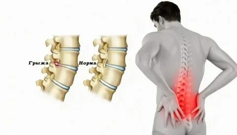 Может ли грыжа не болеть вообще — и это нормально?