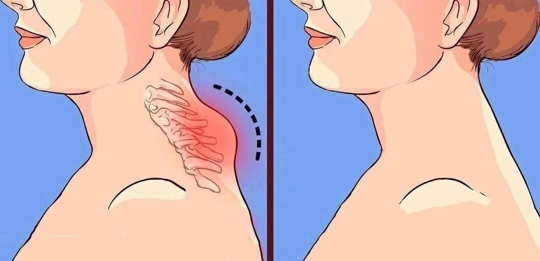 3 упражнения — и холка уйдет навсегда!