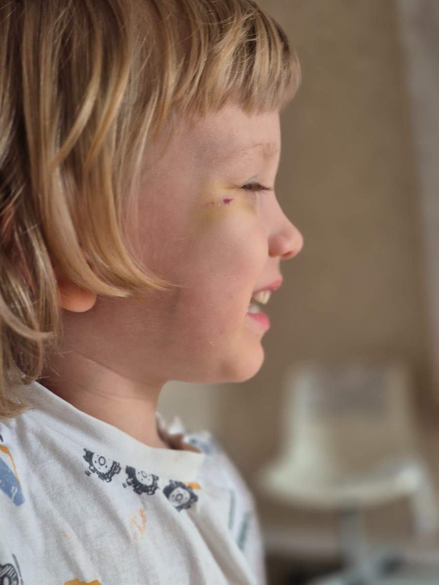 В пятницу Проша пришёл из садика с травмой - девочка деревянной машинкой случайно ударила (крутила её за верёвочку в воздухе, а Проша мимо пробегал 🫢), а в субботу слёг с температурой.