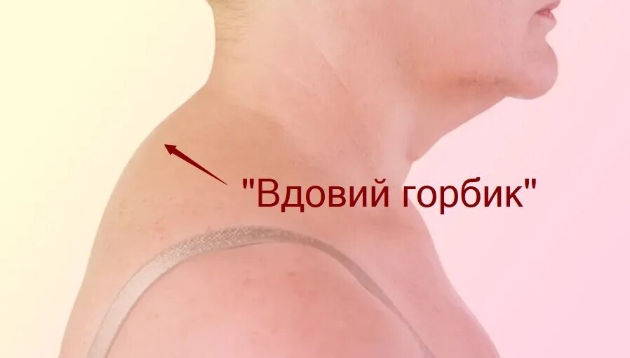 Вдовий горб: 3 причины появления и 5 упражнений, которые работают