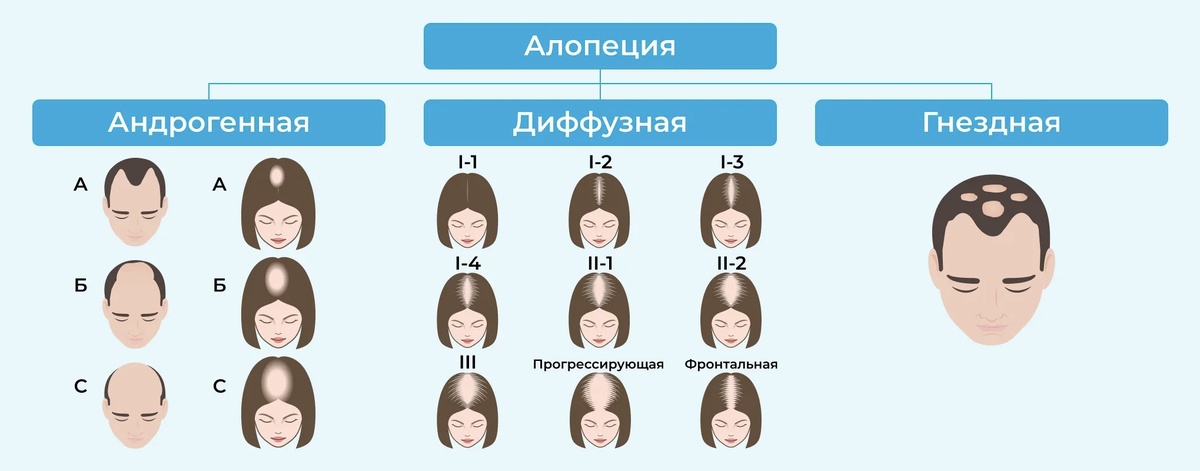 Изображение: разные виды алопеции у мужчин и женщин