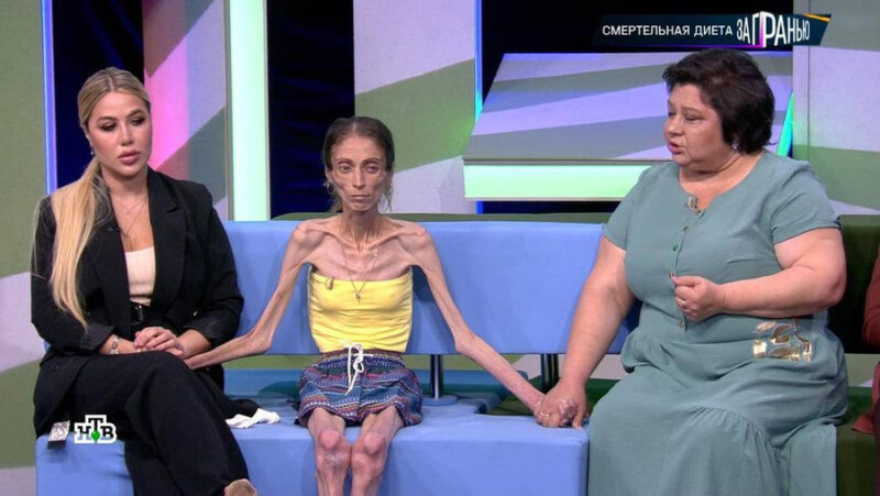    Яна Боброва в критическом состоянии, когда её вес опустился до 20 килограммов.