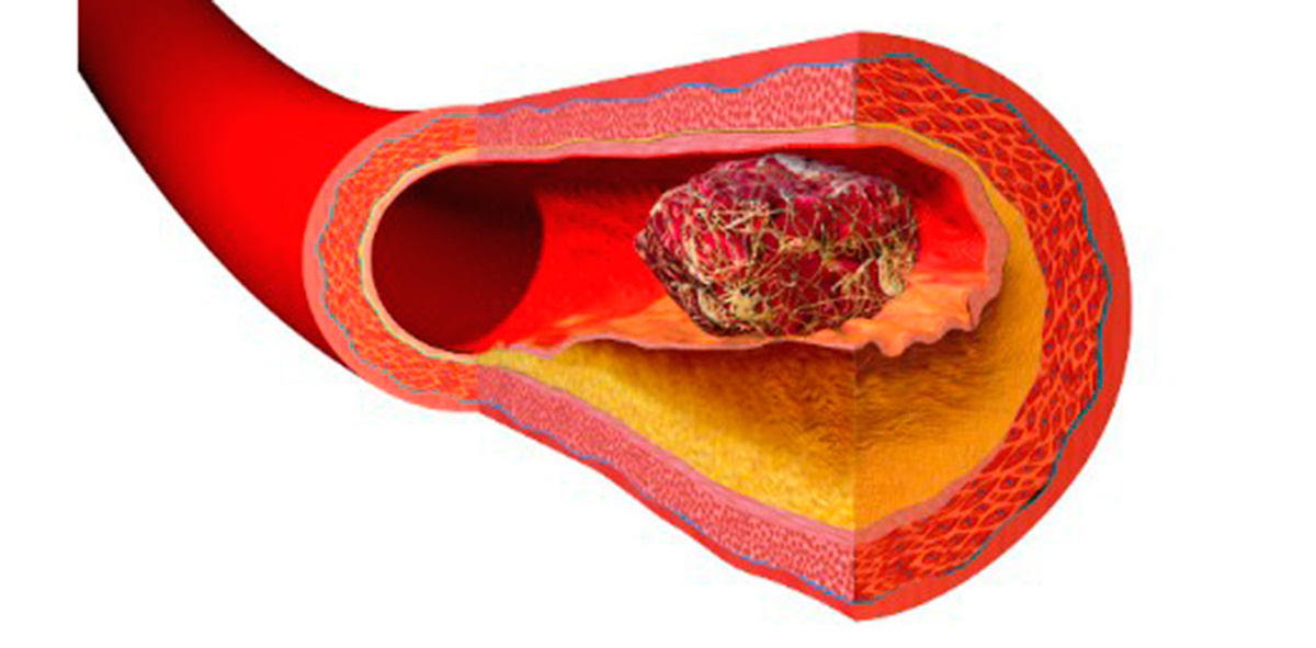 Тромб в кровеносном сосуде 