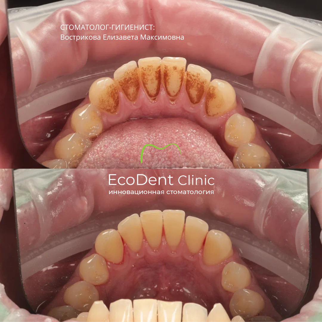 Процедура: профессиональная гигиена полости рта, стоматология ЭкоДент, Астрахань.