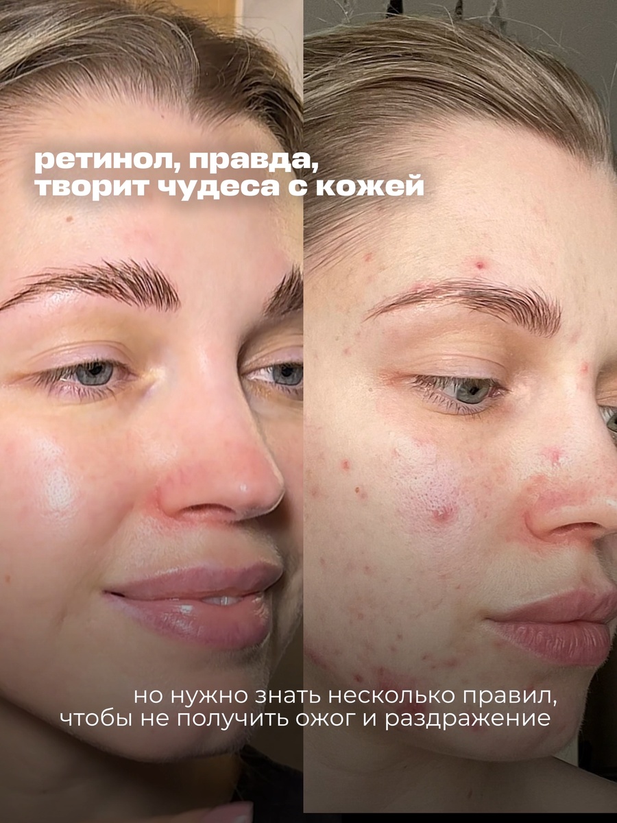 Этот компонент может реально преобразить кожу, но только если использовать его правильно.