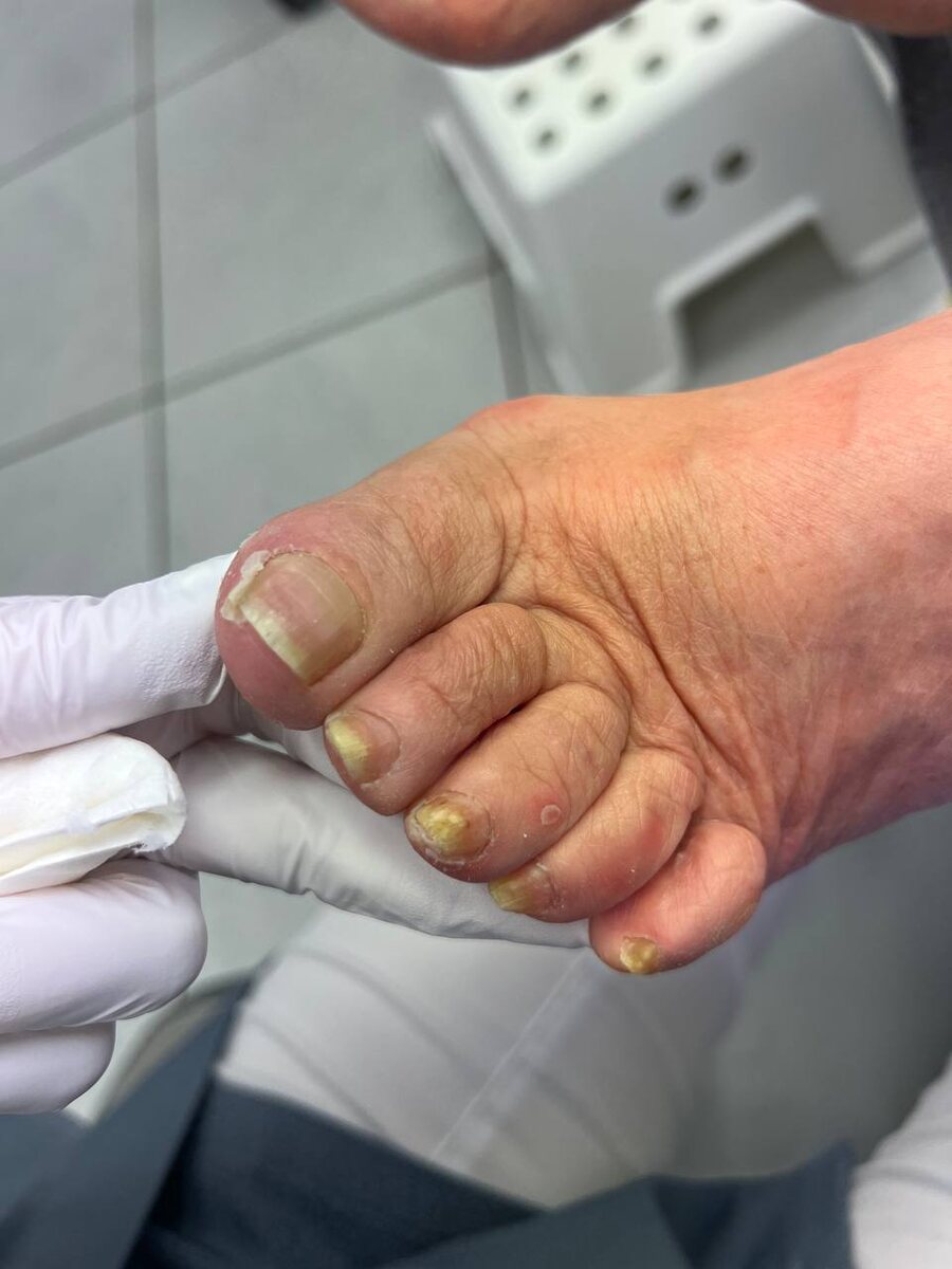 До обращения к подологу