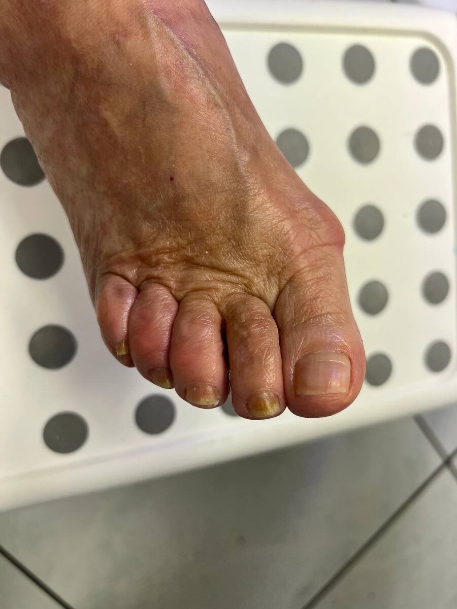 После первой обработки подологом