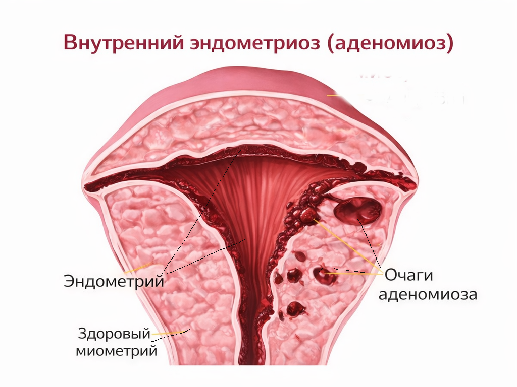 Внутренний эндометриоз (аденомиоз)