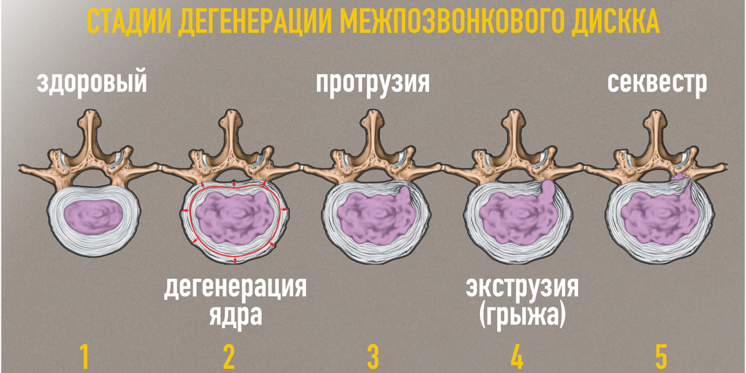 Грыжи позвоночника рассасываются в 70% случаев и почему не нужно спешить с операцией