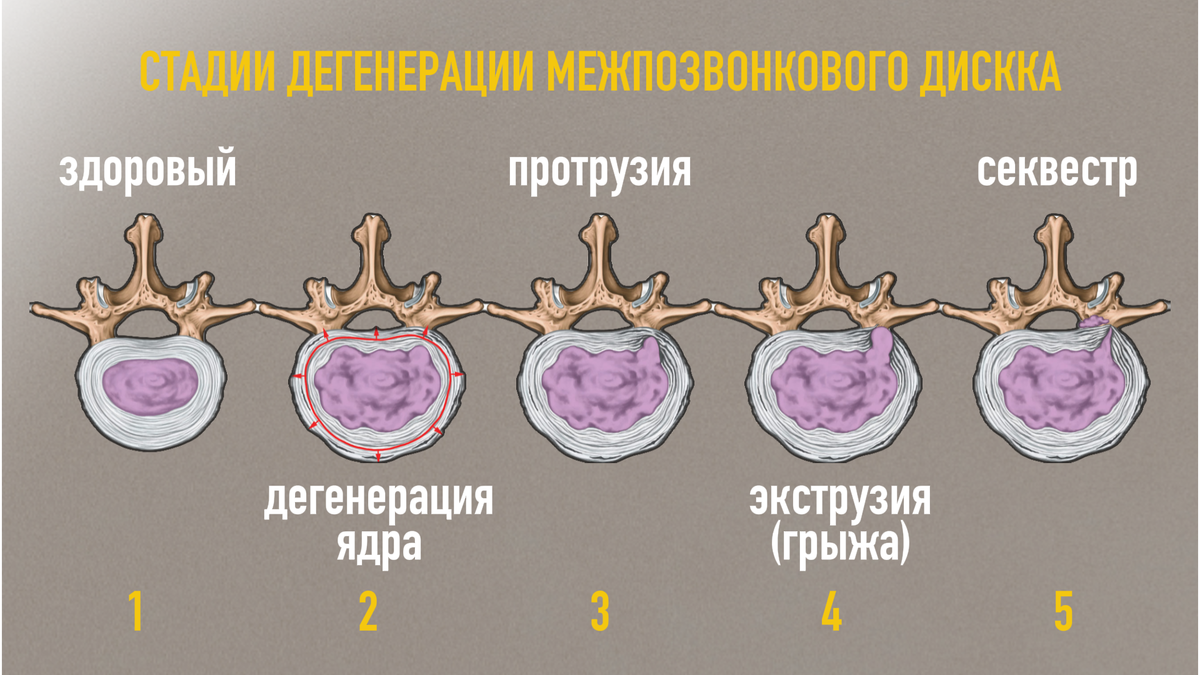 Стадии дегенерации межпозвонкового диска