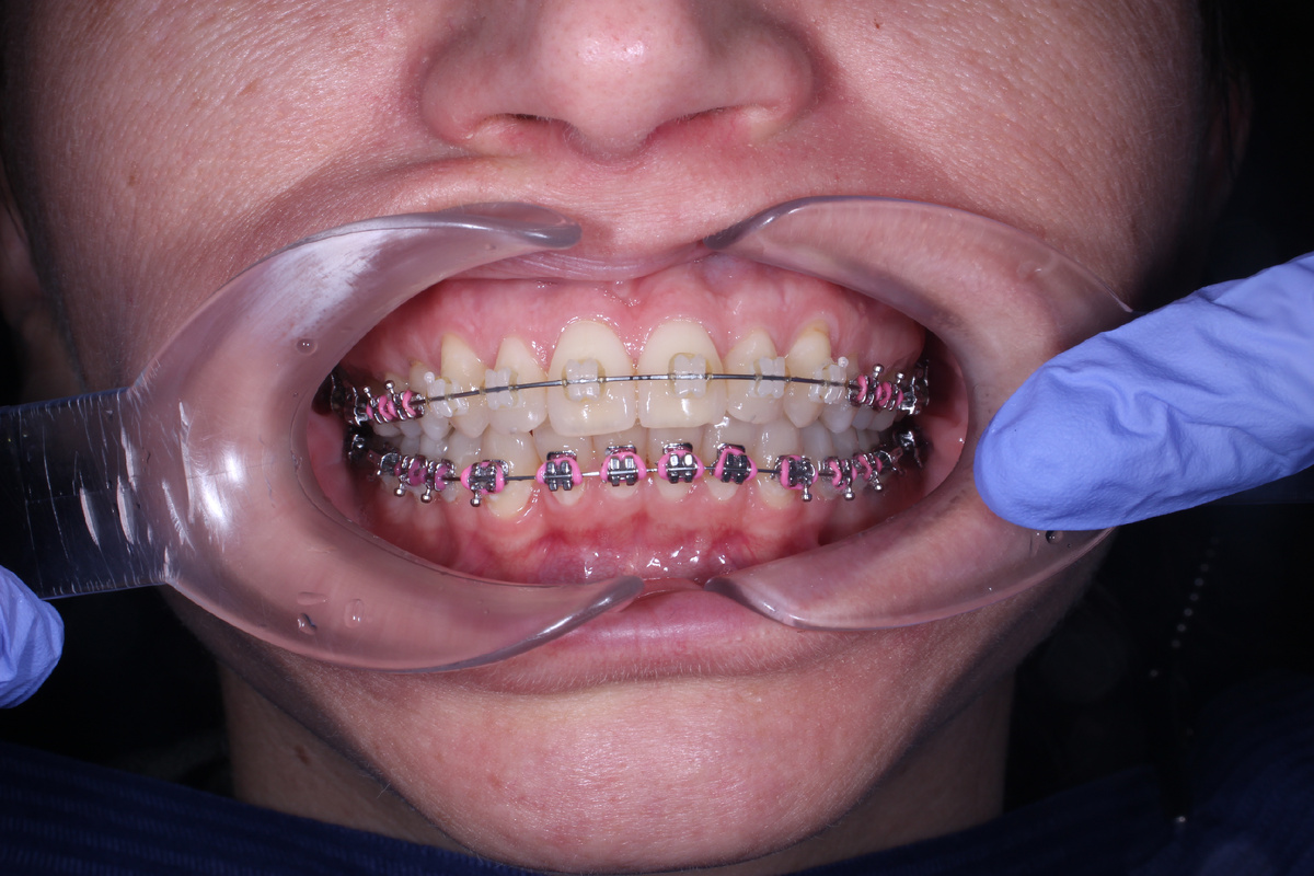 Стоматология Премоляр