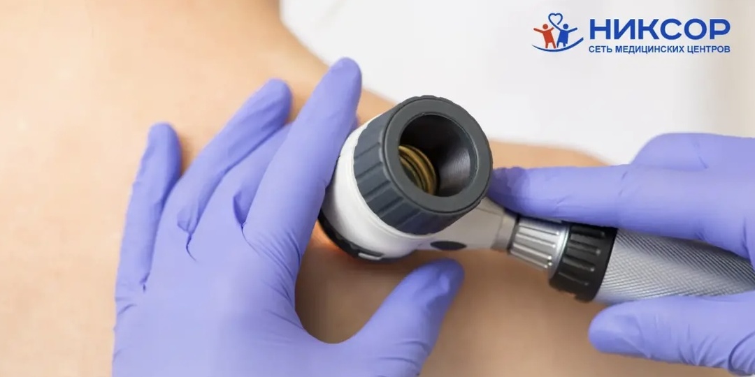 Гемангиома: что важно знать о доброкачественных, сосудистых образованиях.