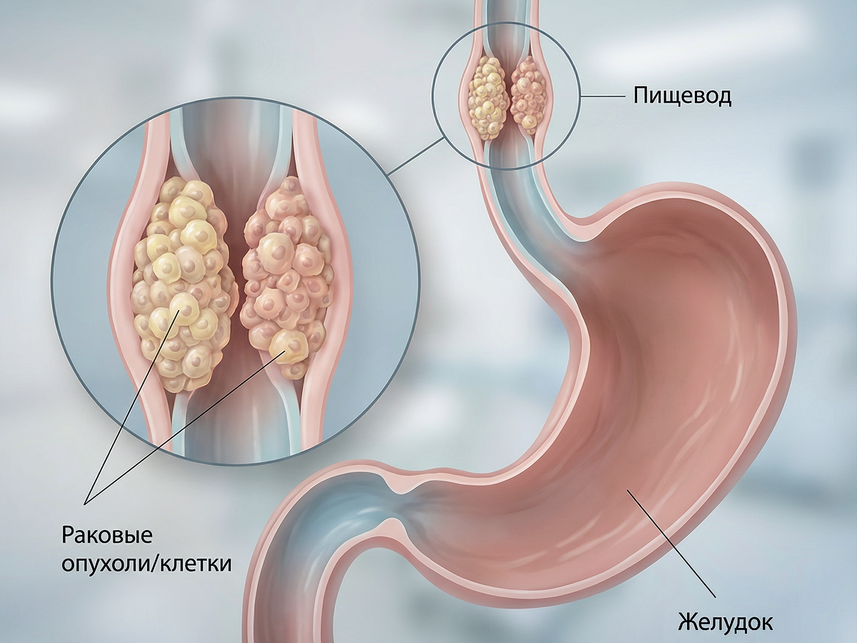 Раковые клетки растут на стенках органа, перекрывая проход
