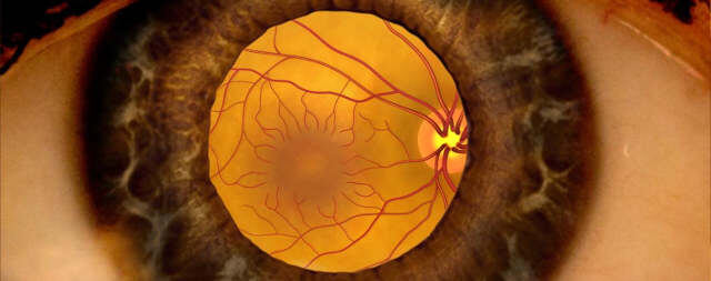 Как следует лечить диабетический макулярный отёк?