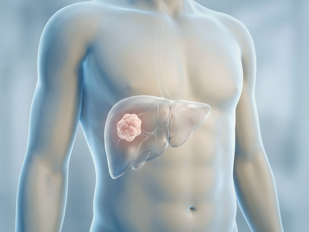 Гепатоцеллюлярная карцинома (ГЦК) — наиболее частая первичная злокачественная опухоль печени (до 90% случаев)
