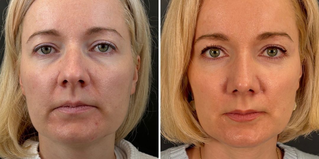 Ринопластика и эндоскопическая подтяжка лба: 1 год после операции