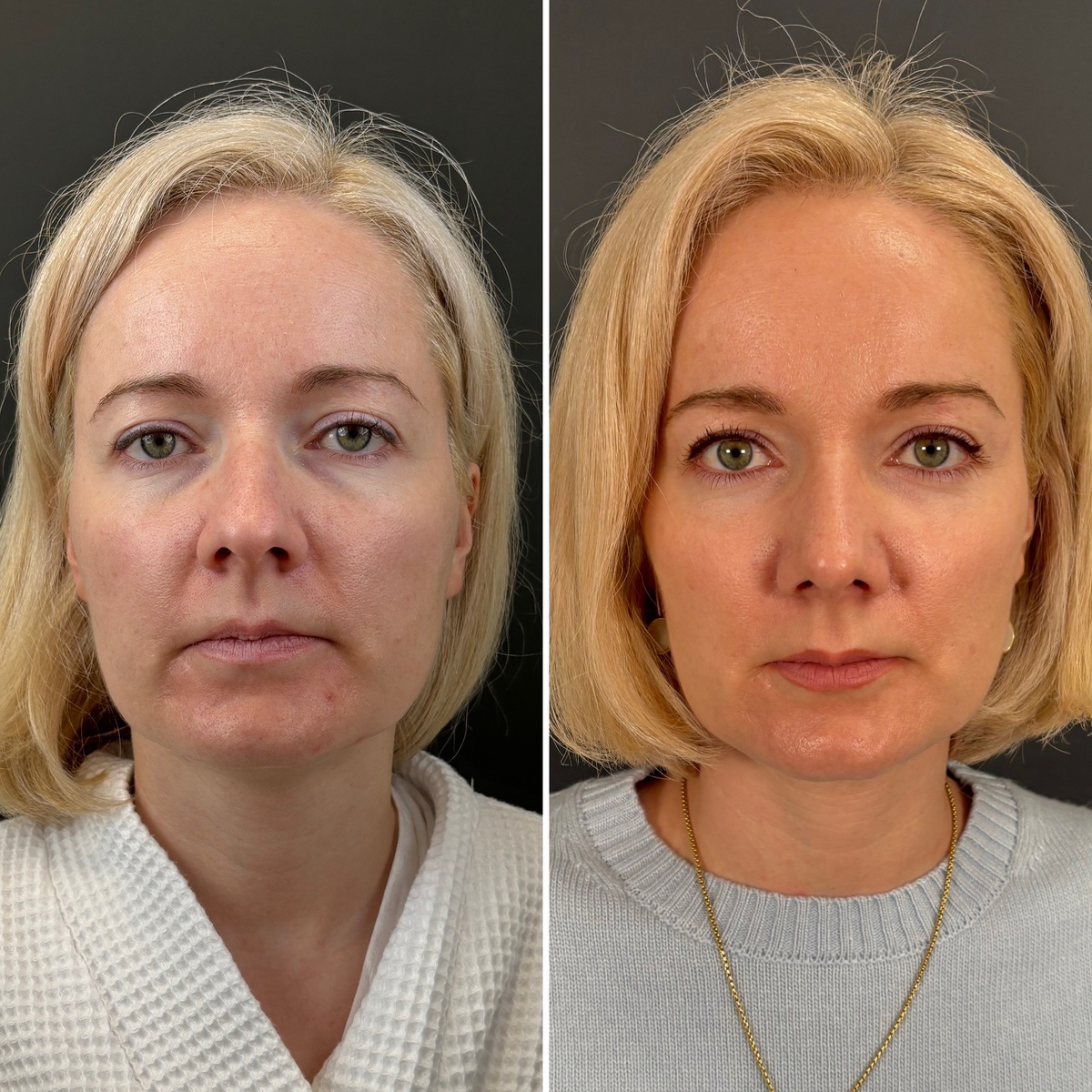 Ринопластика+эндоскопическая подтяжка лба: 1 год после операции (слева- до, справа- после). Хирург Остринская Т.В.