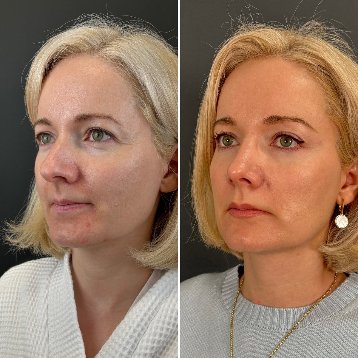 Ринопластика+эндоскопическая подтяжка лба: 1 год после операции (слева- до, справа- после). Хирург Остринская Т.В.