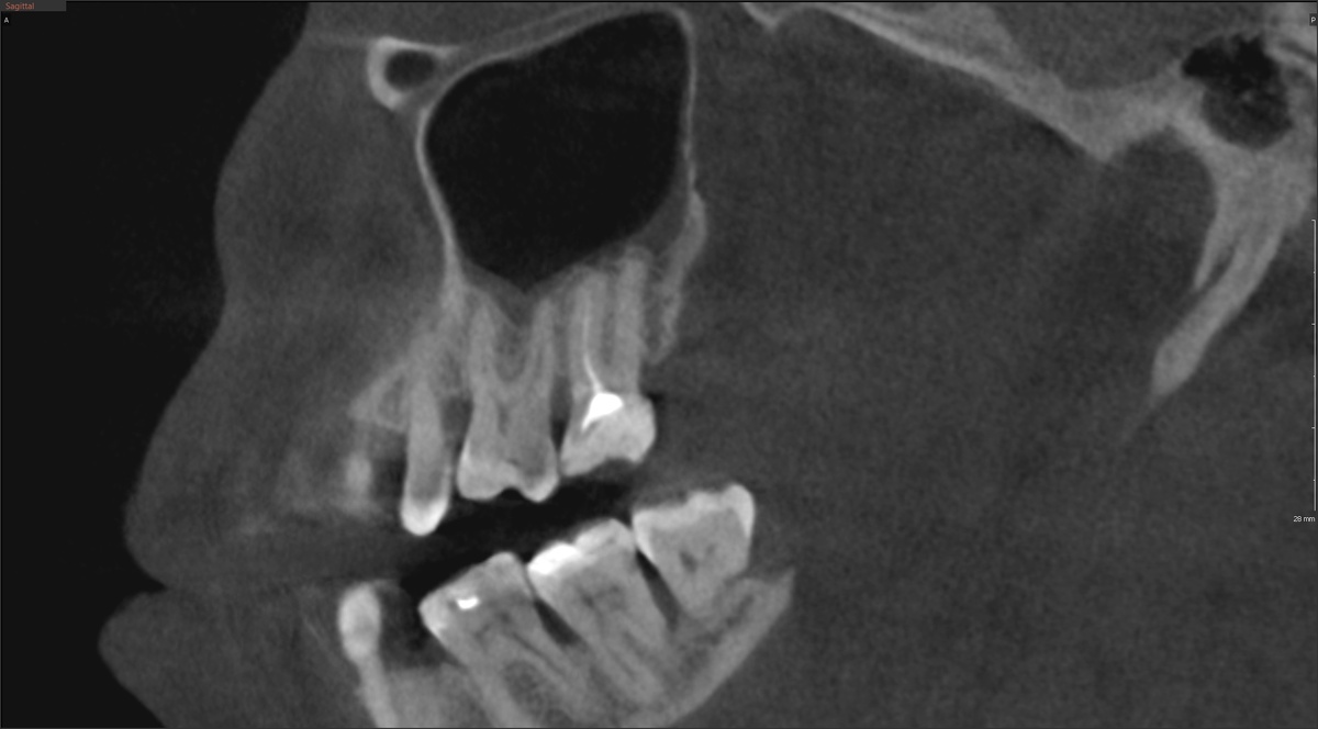 КТ до перелечивания