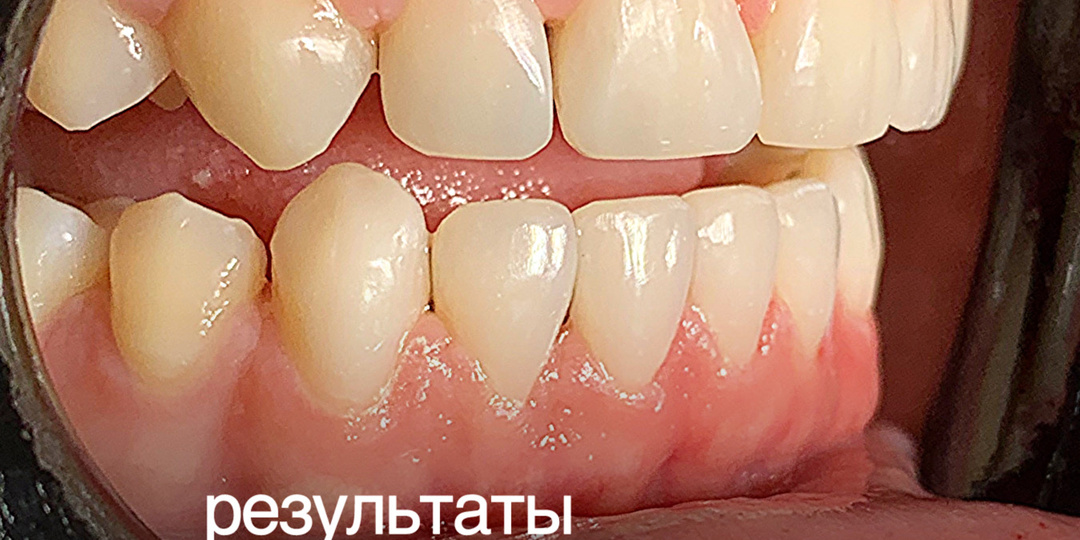 Реставрация зубов при микродентии