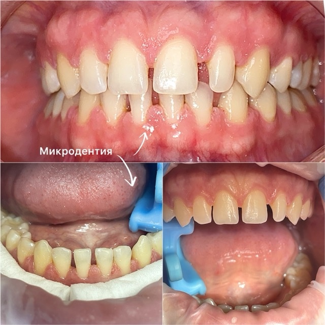 Микродентия - это промежутки между зубами