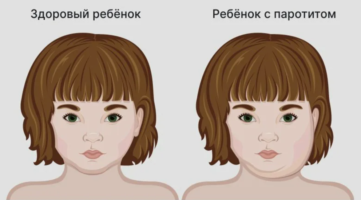 Обычно при паротите всё начинается как обычная вирусная инфекция. Через некоторое время увеличиваются околоушные слюнные железы — лицо становится характерно «припухшим», иногда болезненным при жевании и разговоре.