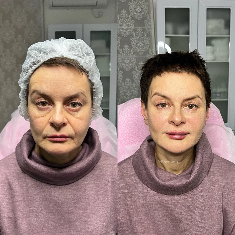 Результат до и поле процедуры