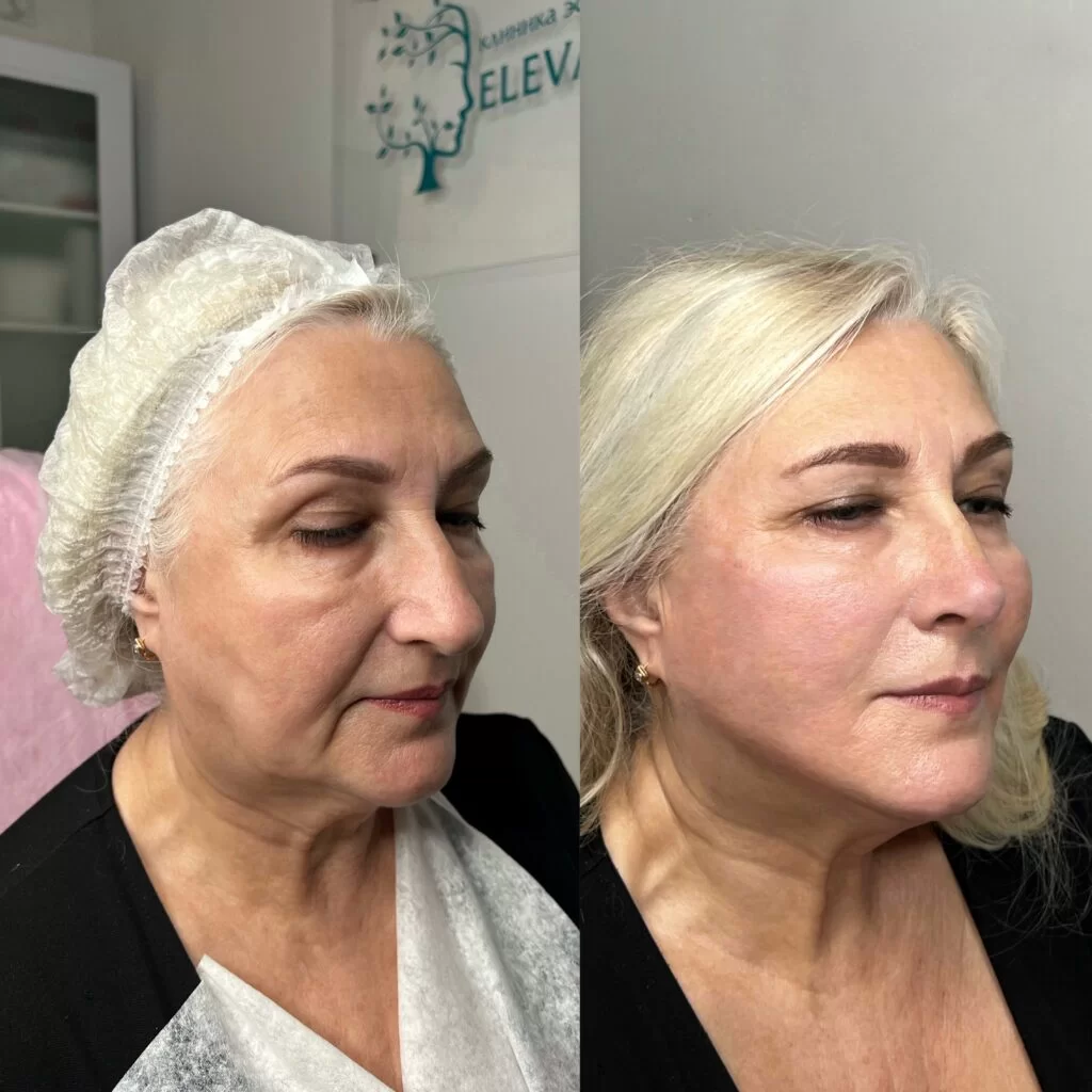 Результат до и поле процедуры