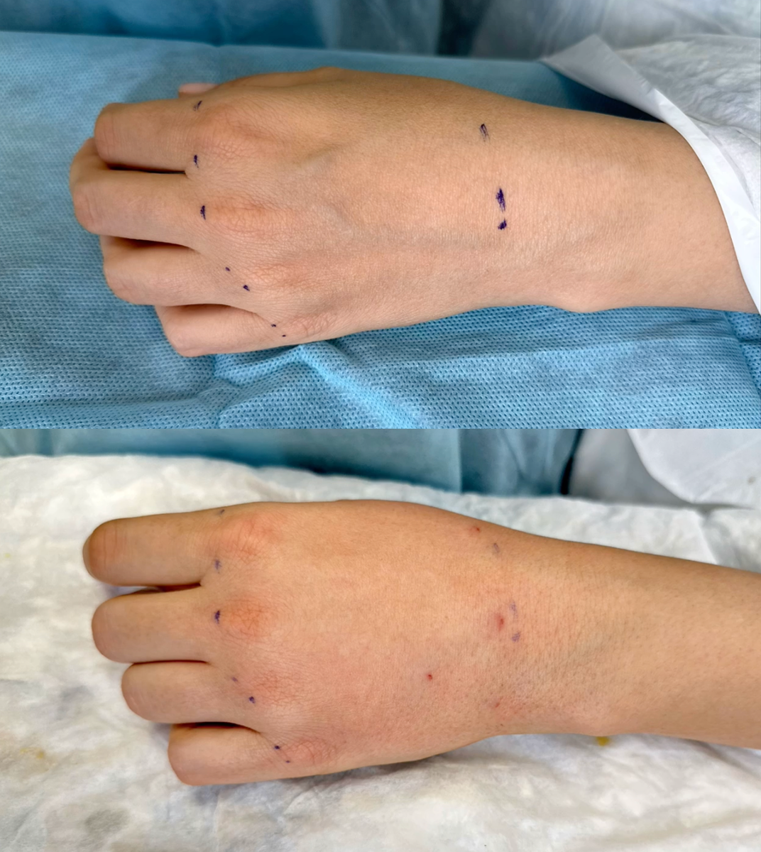 Липосакция кистей рук. Фото до и после. Фото с сайта хирурга Д.Р. Гришкяна. Имеются противопоказания, требуется консультация специалиста.