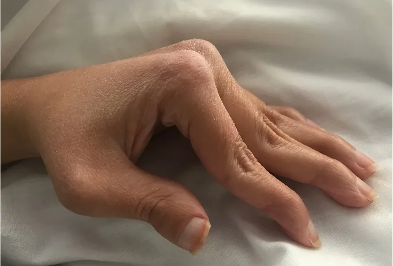 Ревматоидный артрит кистей: когда слабеют мышцы и как вернуть силу рукам