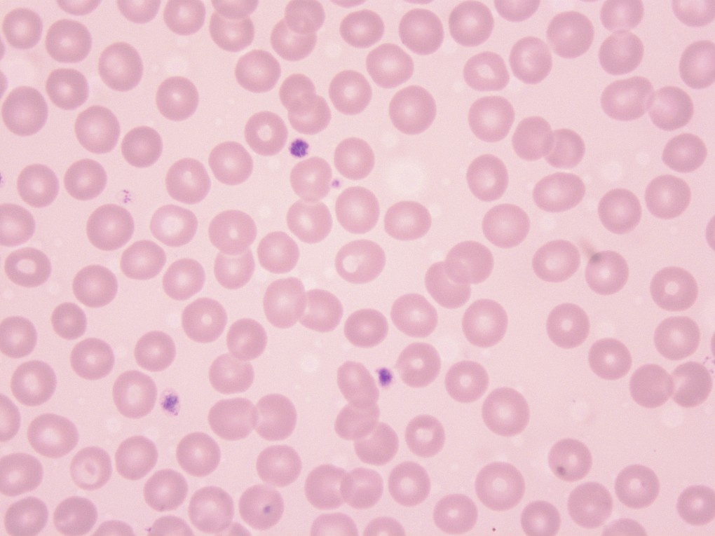 Эритроциты с нормальной морфологией в мазке периферической крови (световая микроскопия, окраска по Паппенгейму, увеличение х1000)