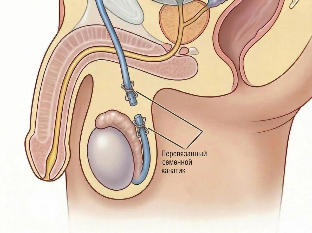 Вазэктомия (вазорезекция) .Суть метода.