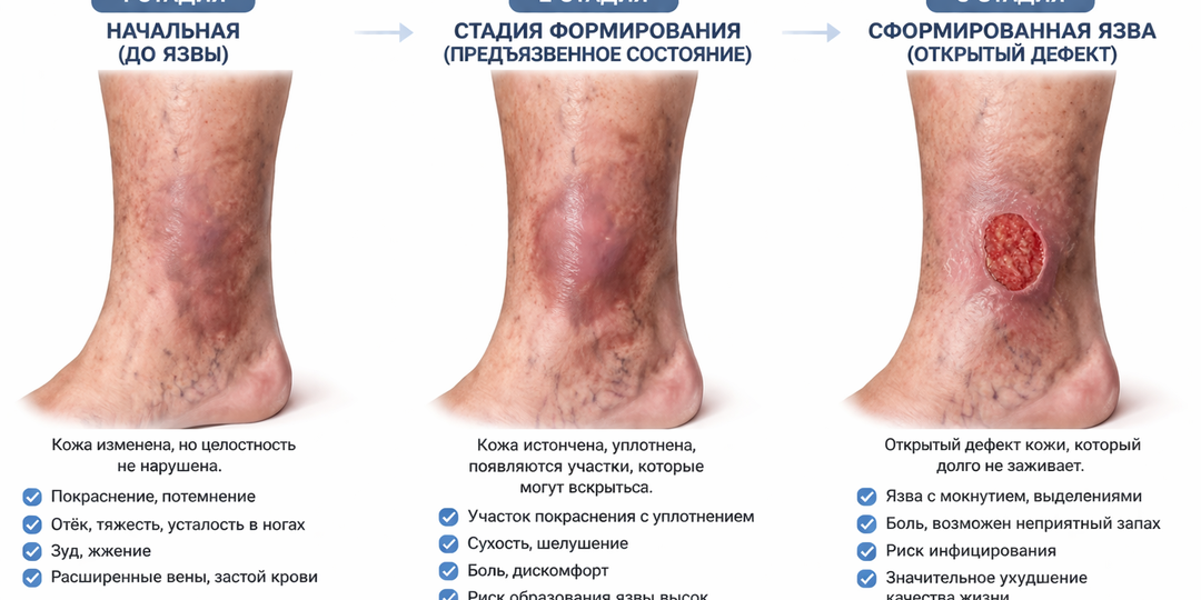 Язва на ноге: почему она возникает и как лечить