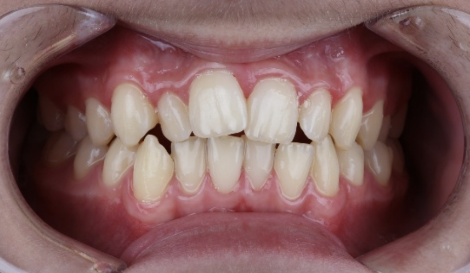 Влияют ли зубы мудрости на скученность резцов?