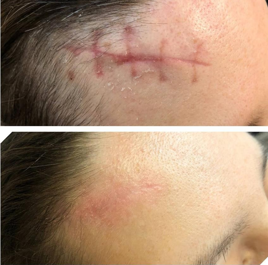 Шлифовка шрама. Клиника «Доклазер» Врач — косметолог, онколог — дерматолог Новиков Кирилл Александрович