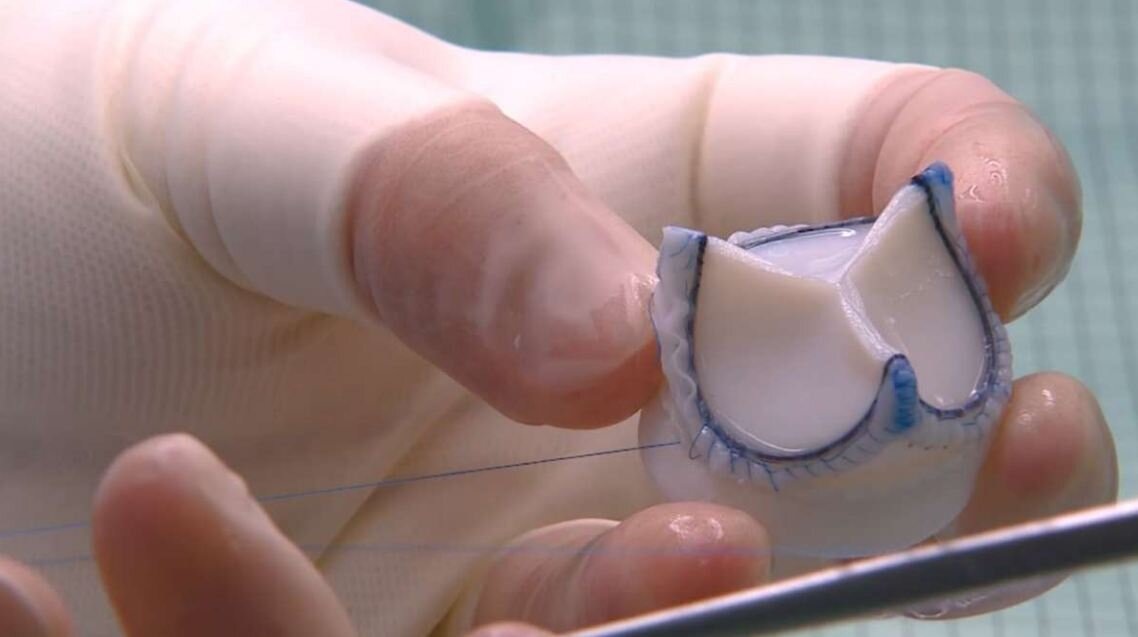 В конструкции биопротеза клапана сердца использован композитный каркас, состоящий из полипропиленовой формы и суперэластичной проволоки с памятью формы. Каркаса клапана обшит биологической тканью, что позволяет проводить специальную обработку всей поверхности. Источник: пресс-служба компании «НеоКор».