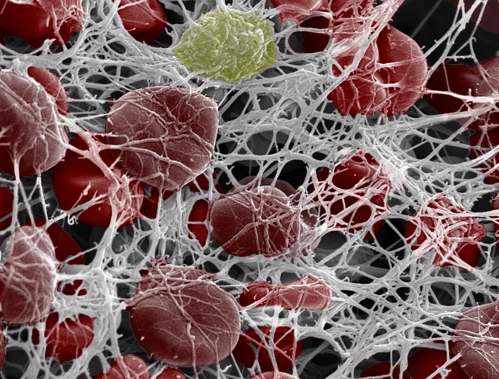 Белые - фибриновые нити, светоло-желый - тромбоцит, красные - эритроциты.