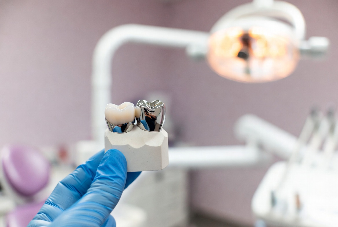 Металлокерамическая коронка. Стоматология в Щербинке, на Спортивной улице 23