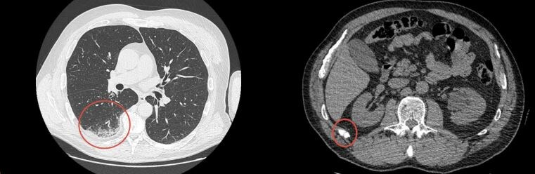 Клинический случай: отсроченная боль в грудной клетке после травмы - перелом ребра и ушиб лёгкого