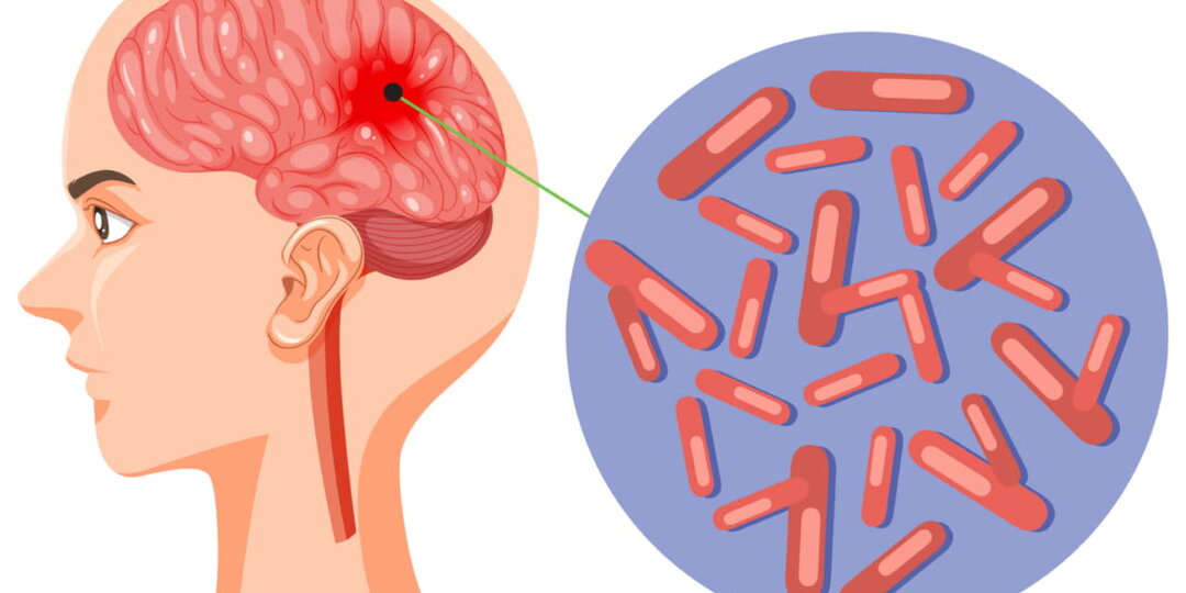 Симптомы менингита у взрослых: первые тревожные сигналы
