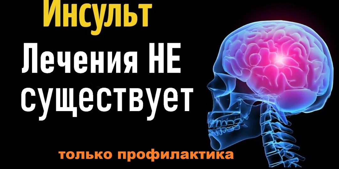 Как понять, что есть риск инсульта