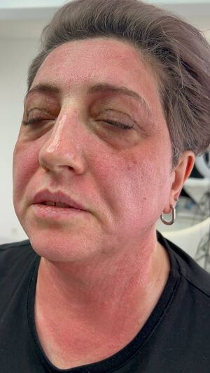 Микроигольчатый RF: что это такое, больно ли и какого результата ждать