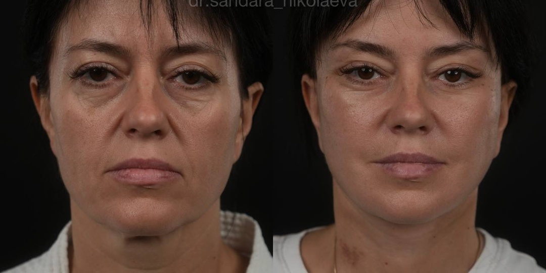 13 сутки после фейслифтинга и височного лифтинга