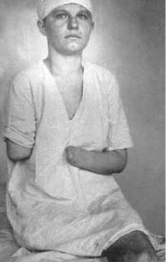 «Русские люди, солдаты, отомстите за меня!»: её знал весь СССР — медсестра, потерявшая руки и ноги, родила четверых детей и получила Звезду