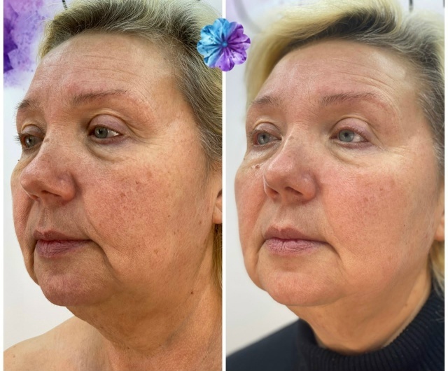 фото ДО/ПОСЛЕ процедуры на косметике CELLOOE