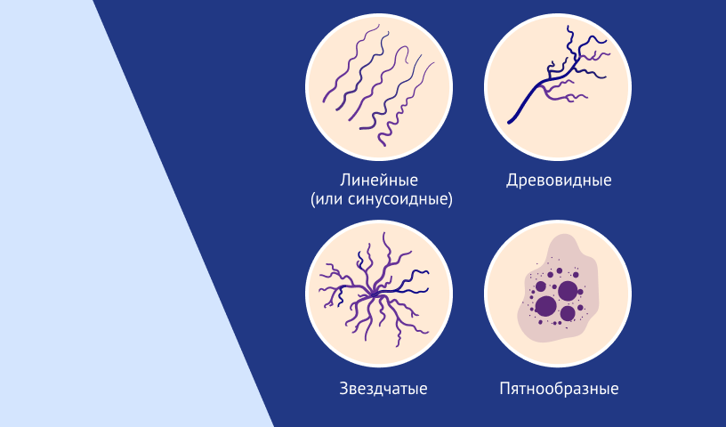 Сосудистые звездочки на лице и ногах: почему они появляются и как от них избавиться навсегда?