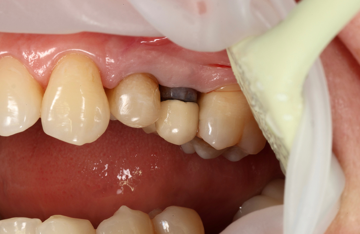 Старая металлокерамика на верхней пятёрке